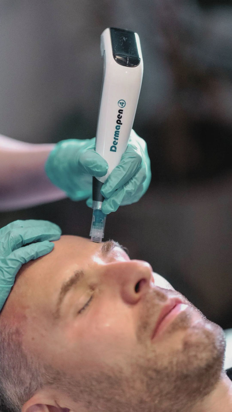 DermaPen microneedling treatment at Hermanos Aesthetics Cape Town for skin rejuvenation and hair growth.